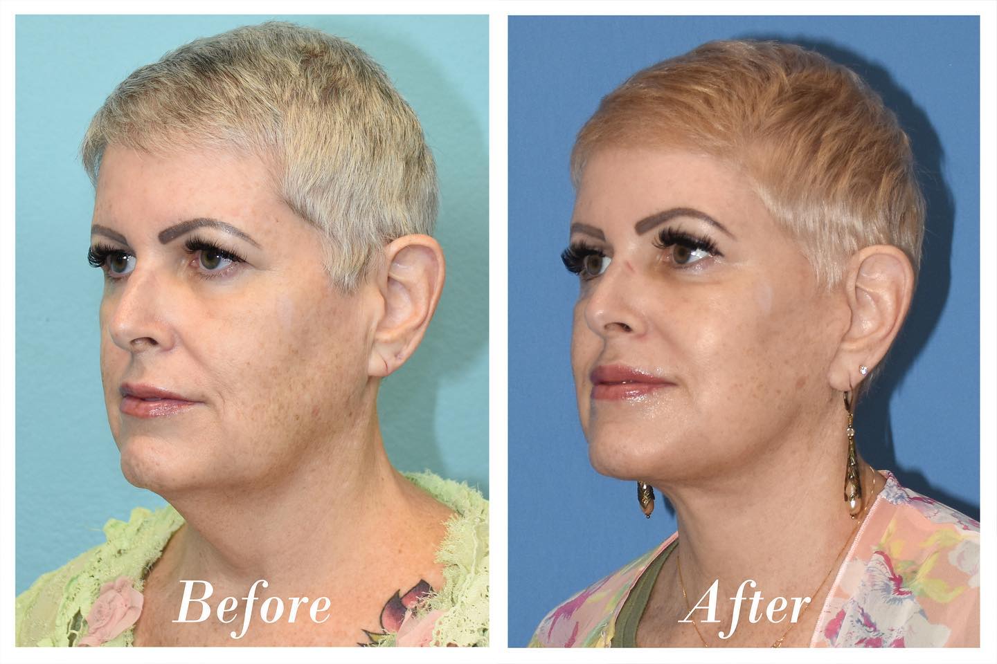 Facelift C02 Laser Skin Resurfacing Before & After Image