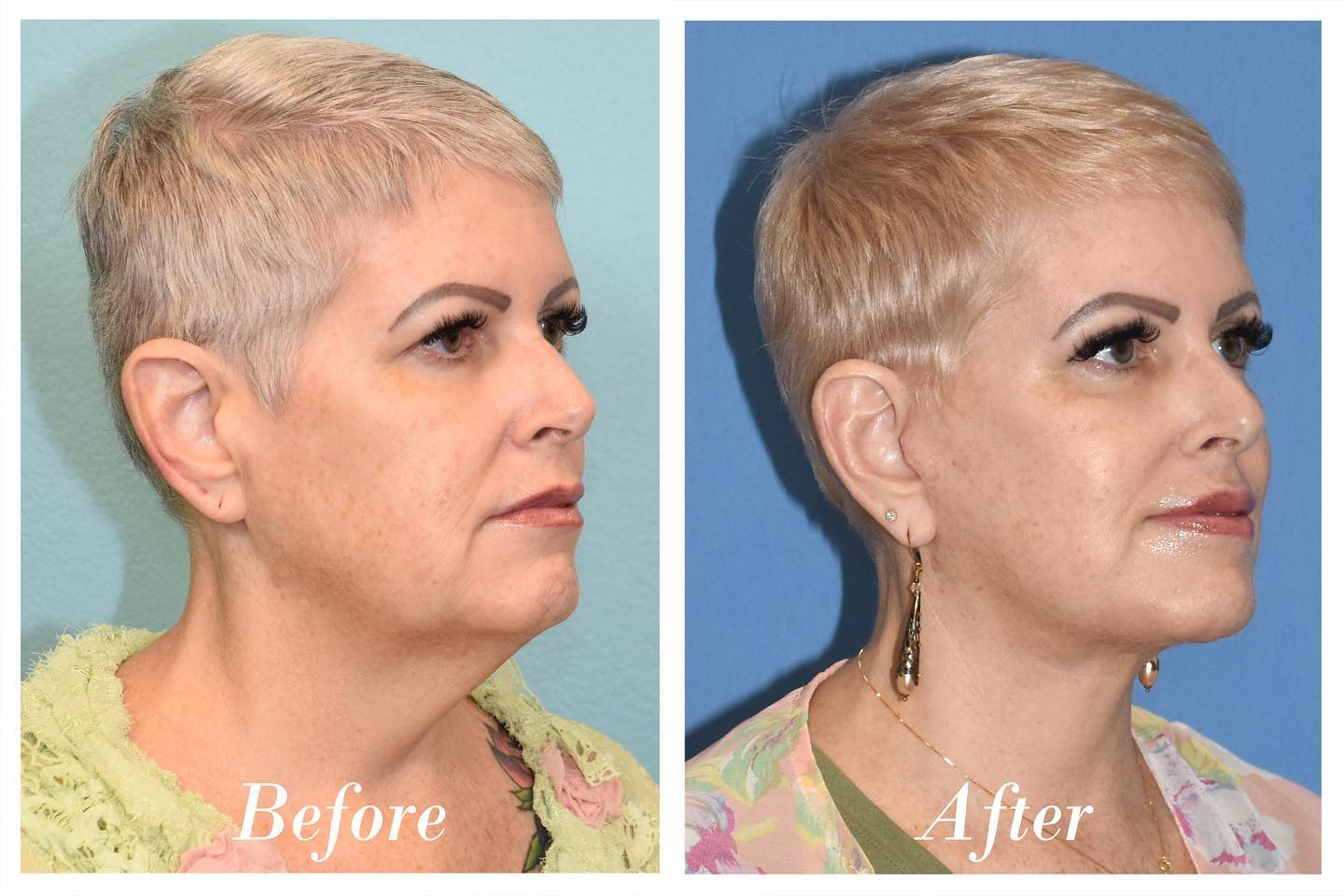 C02 Laser Before & After Image