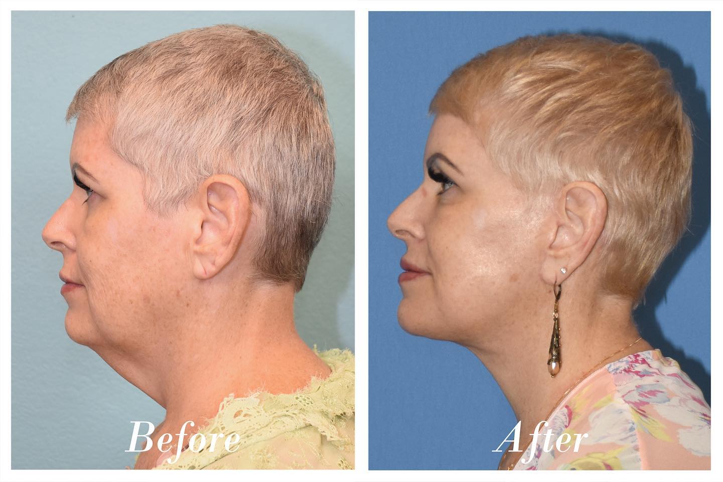 C02 Laser Before & After Image