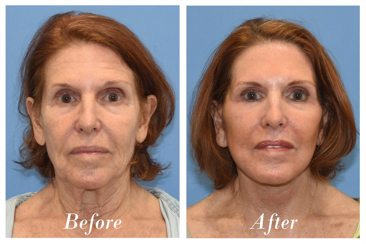 C02 Laser Before & After Image