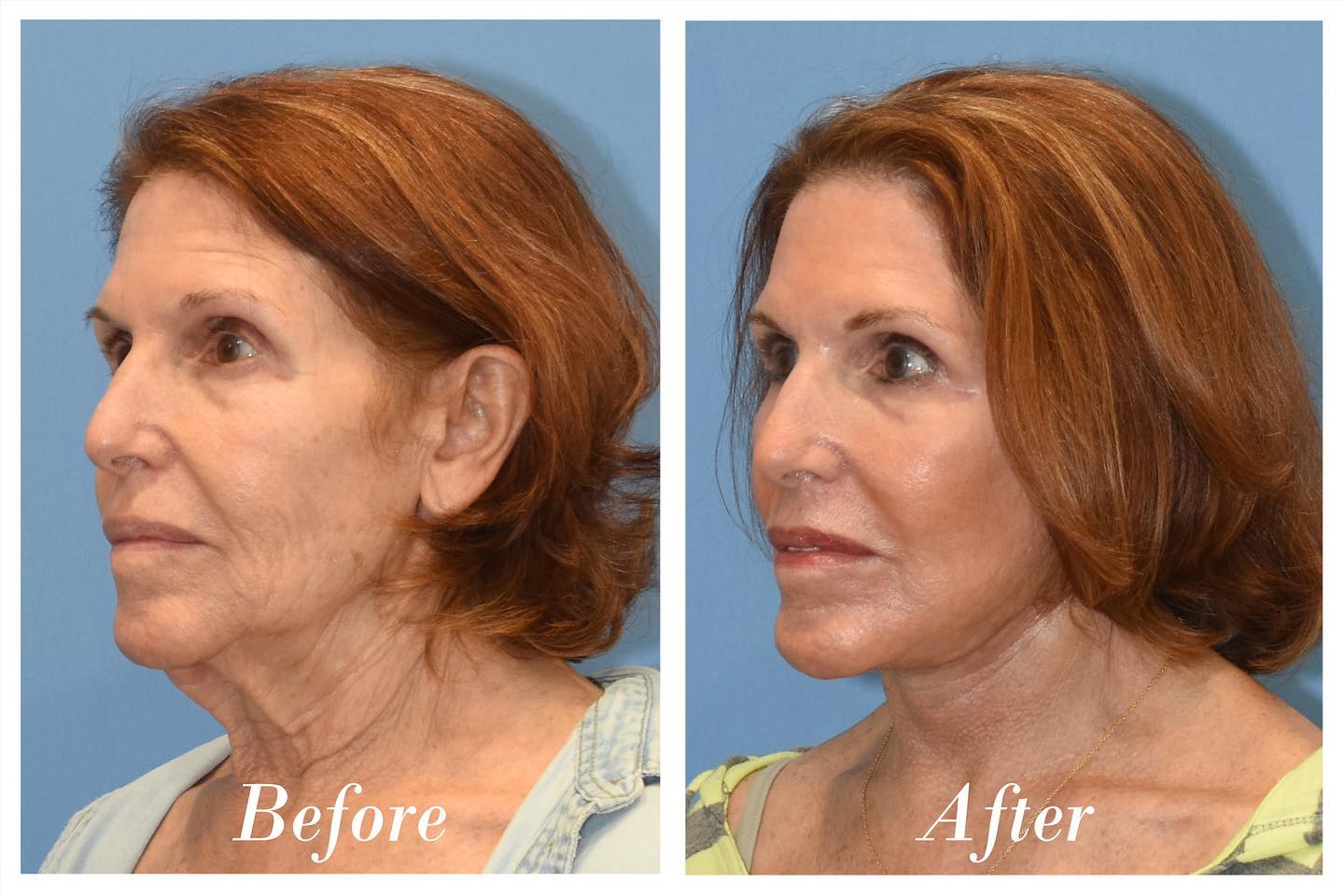 C02 Laser Before & After Image