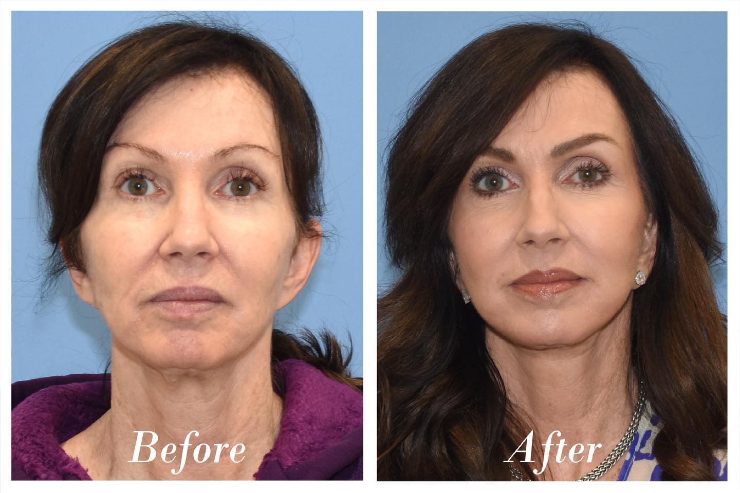 C02 Laser Before & After Image