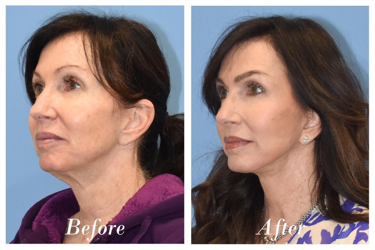 C02 Laser Before & After Image