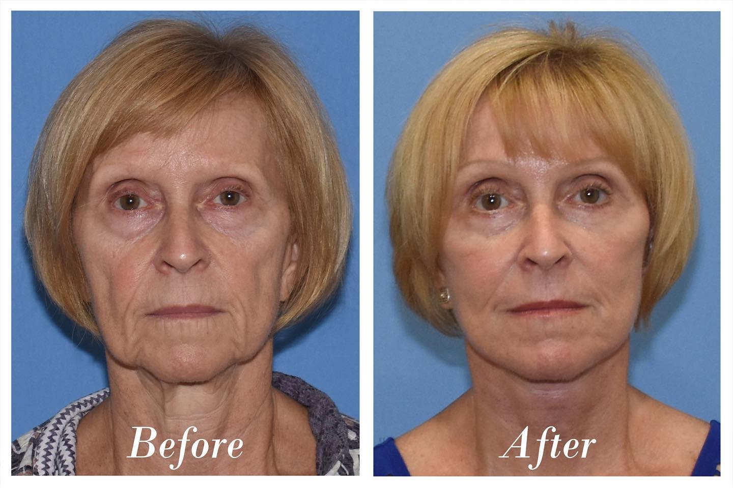 C02 Laser Before & After Image