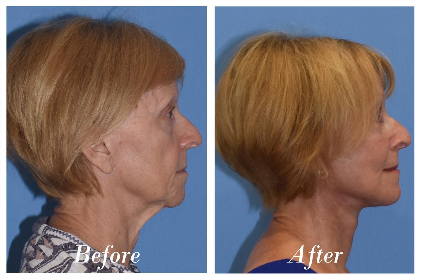 C02 Laser Before & After Image