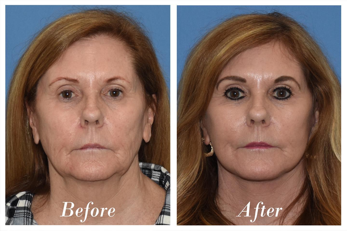 C02 Laser Before & After Image