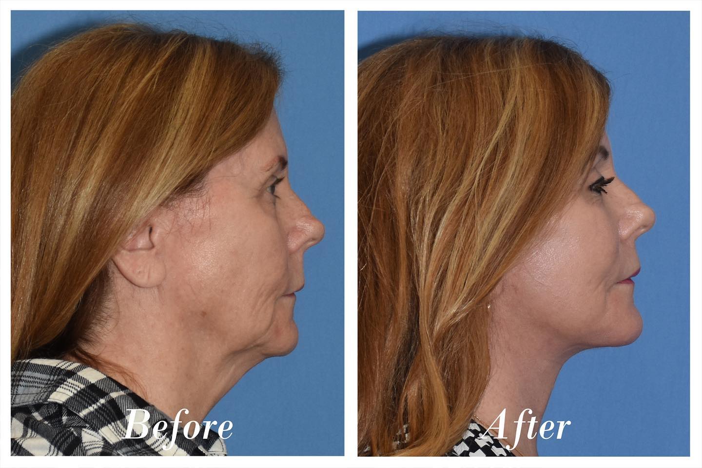 C02 Laser Before & After Image