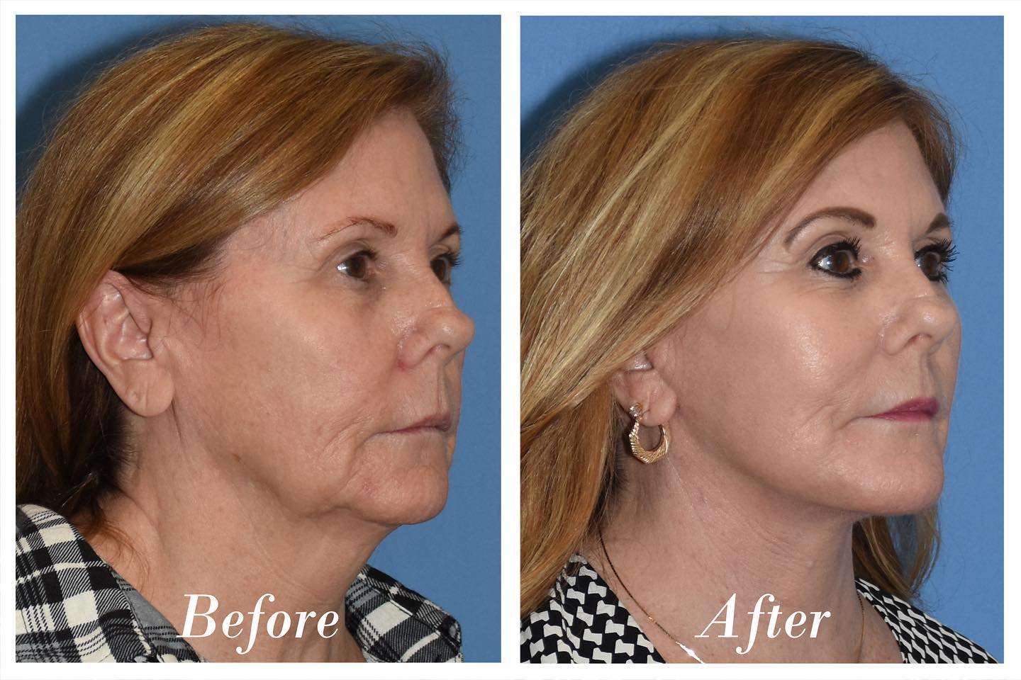 C02 Laser Before & After Image