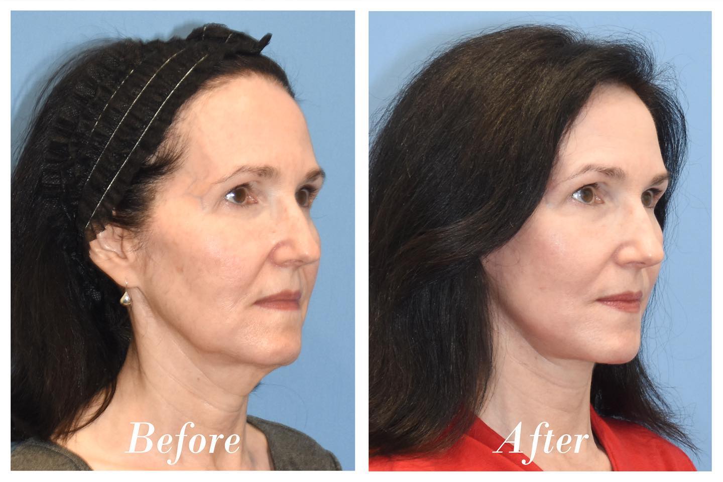 C02 Laser Before & After Image