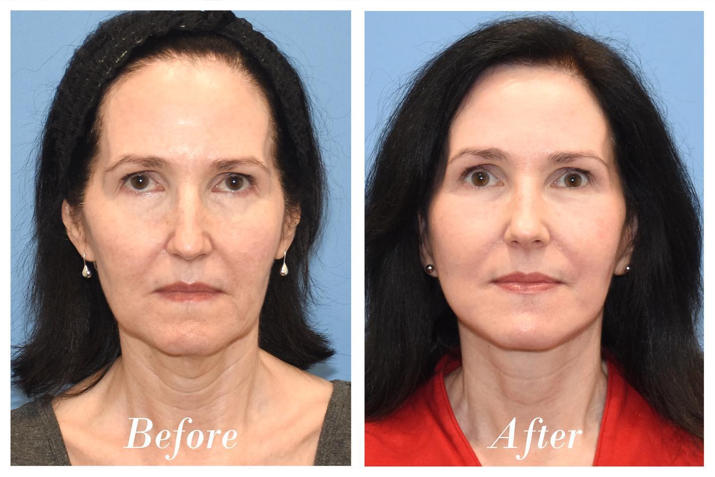 C02 Laser Before & After Image