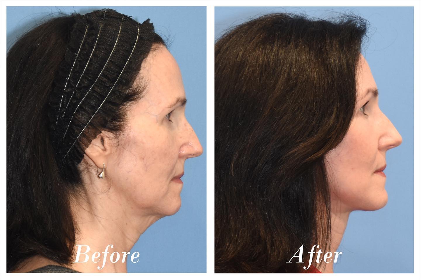 C02 Laser Before & After Image