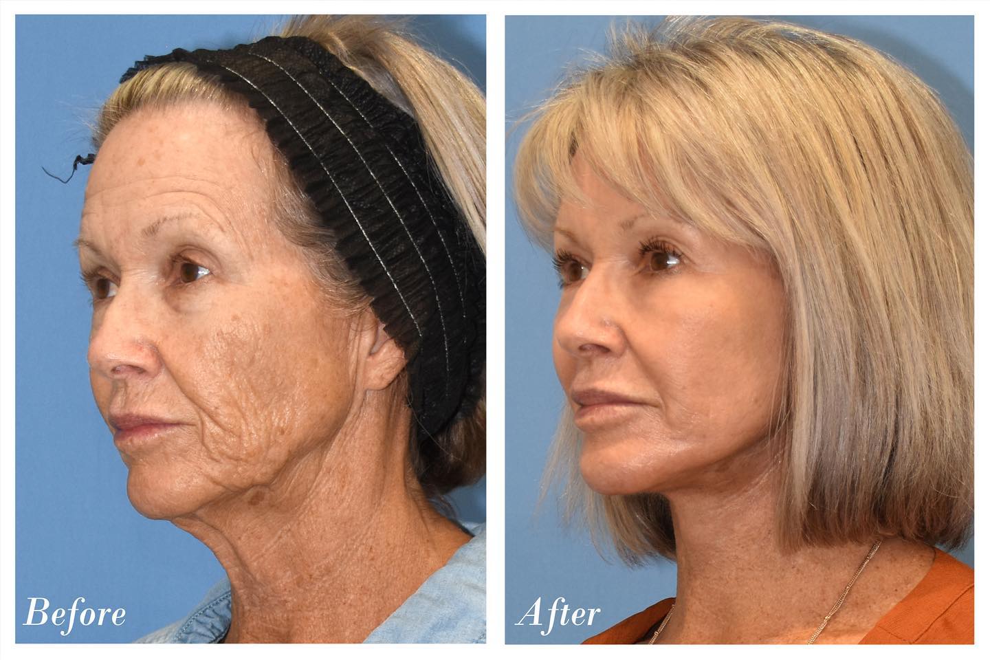 C02 Laser Before & After Image