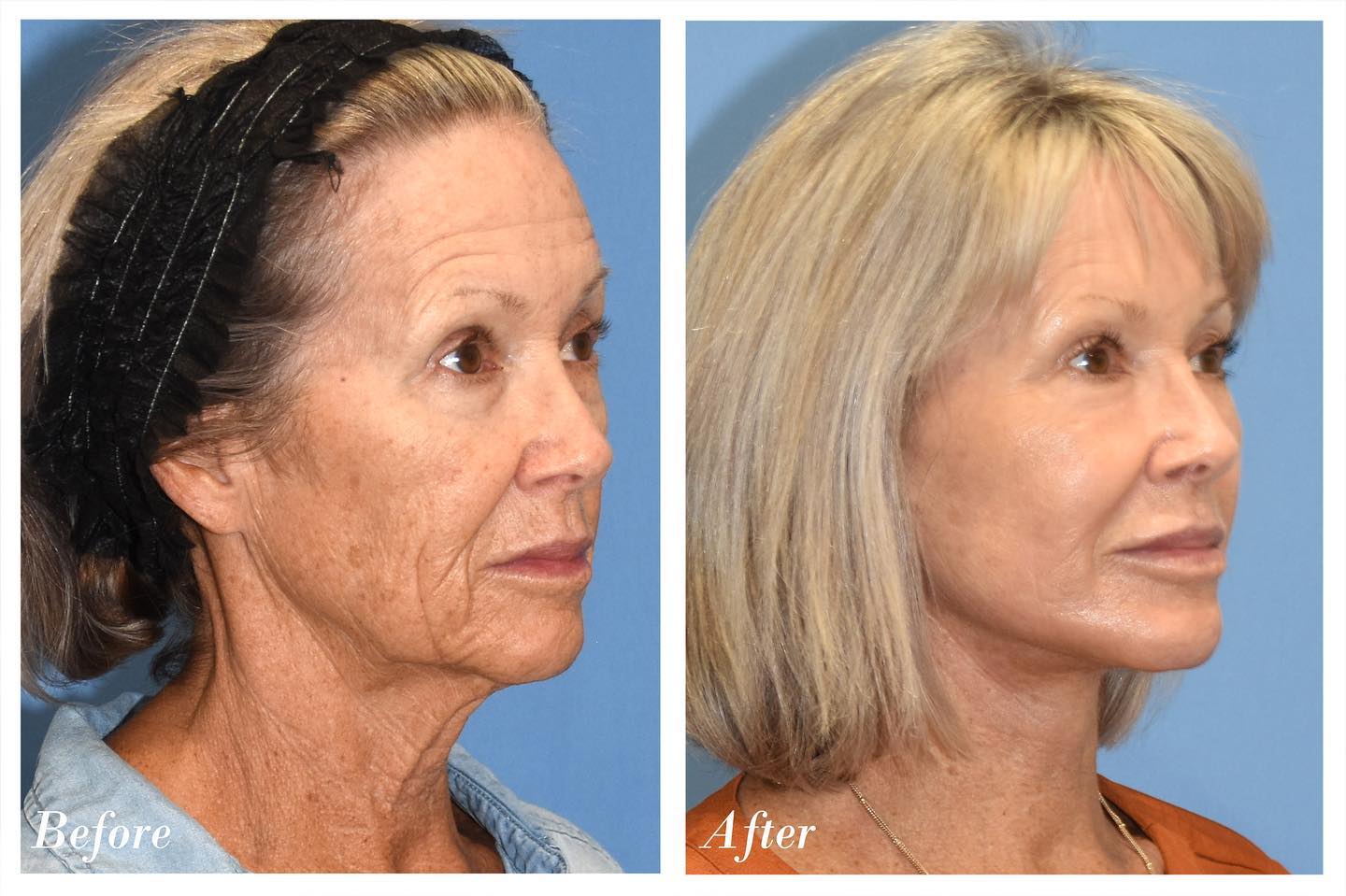 C02 Laser Before & After Image