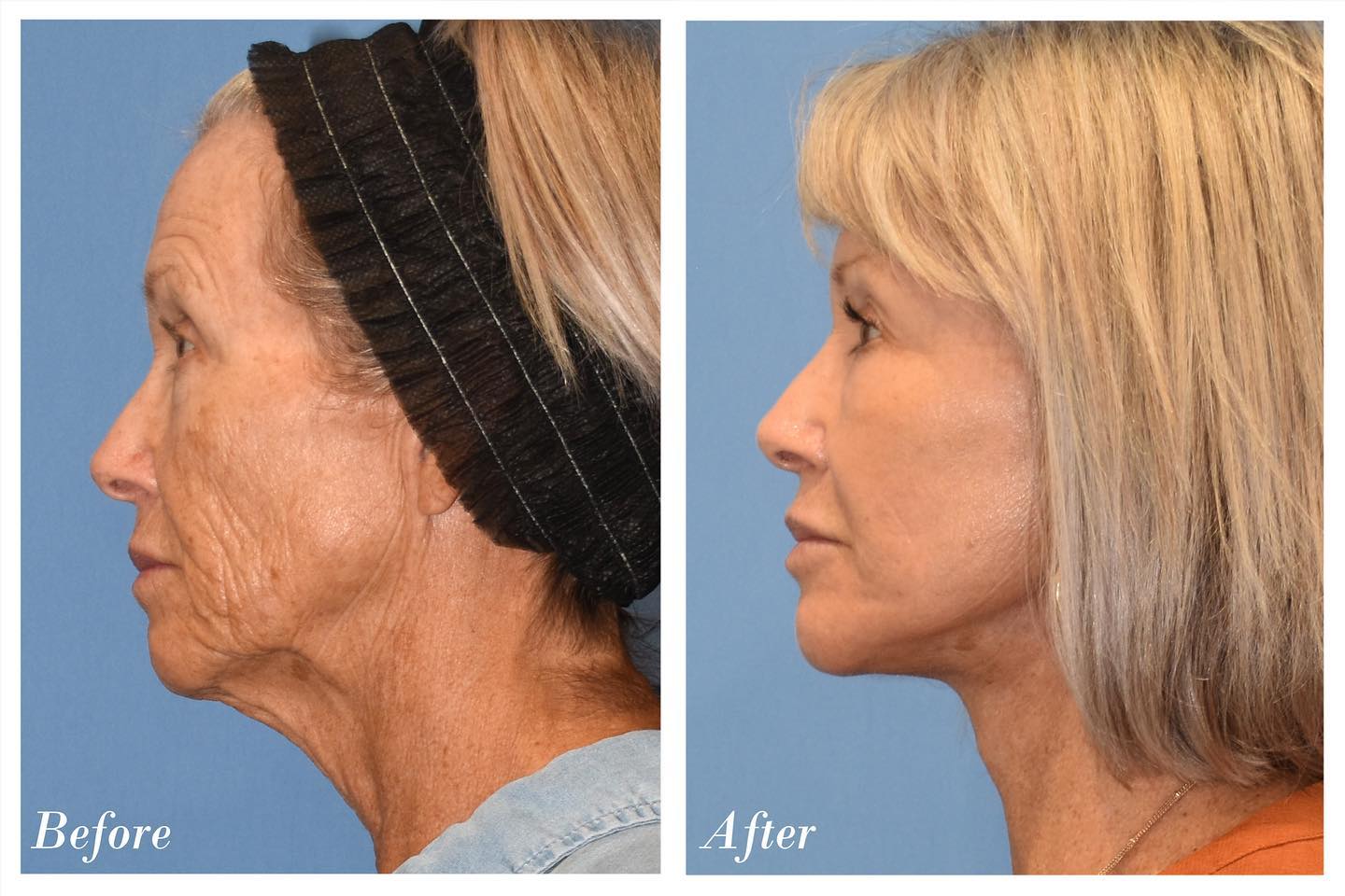 C02 Laser Before & After Image