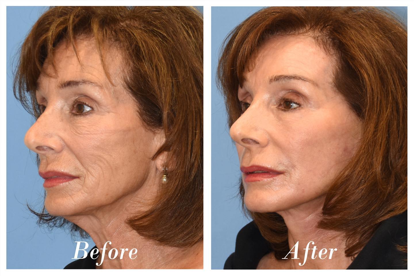 Facelift C02 Laser Skin Resurfacing Before & After Image