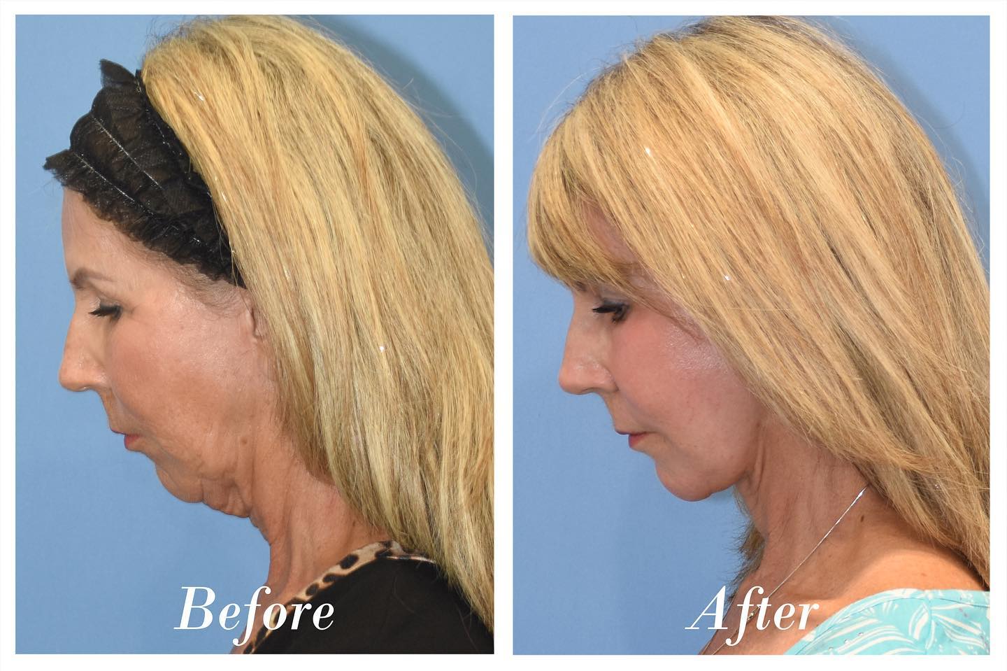 C02 Laser Before & After Image