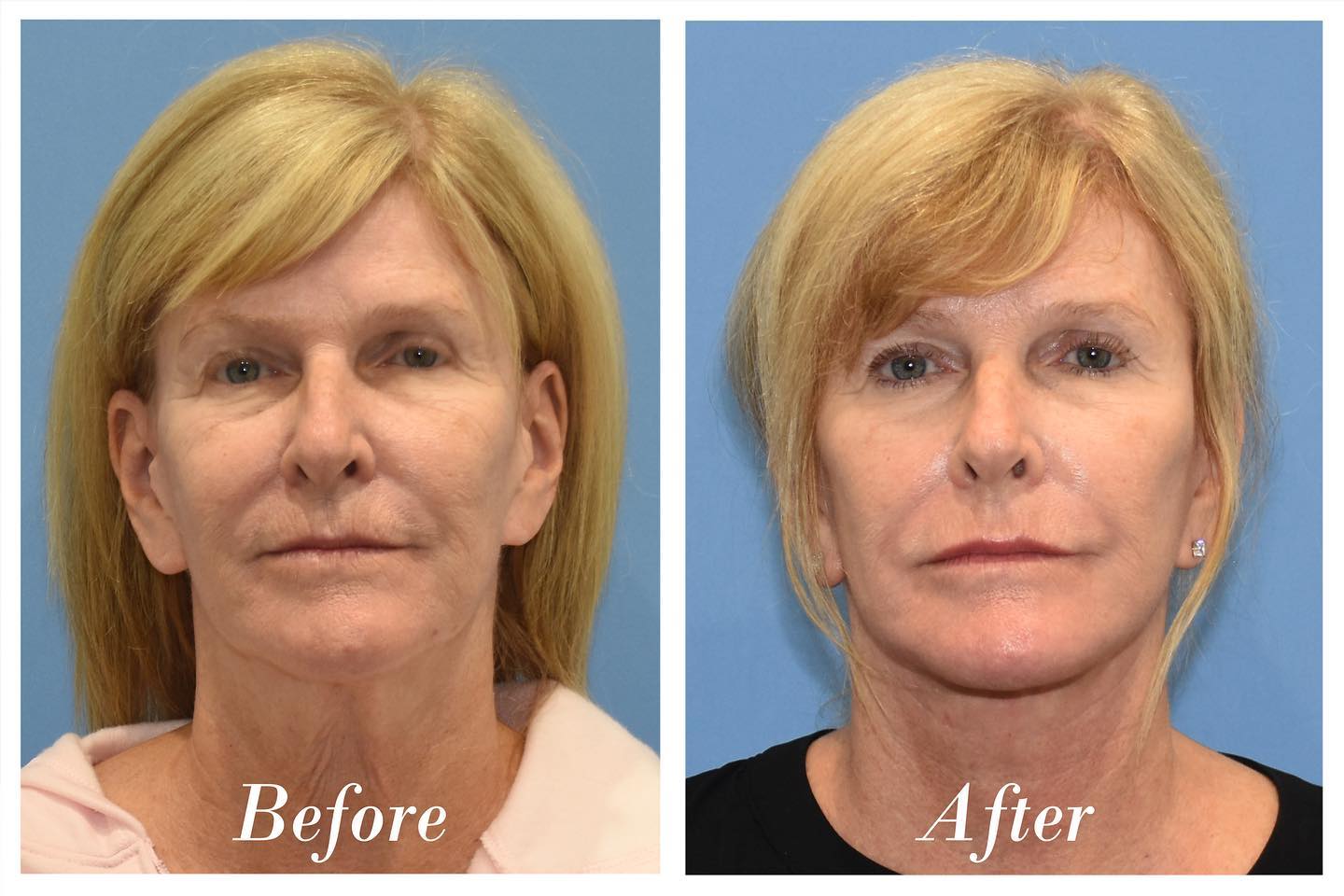 C02 Laser Before & After Image