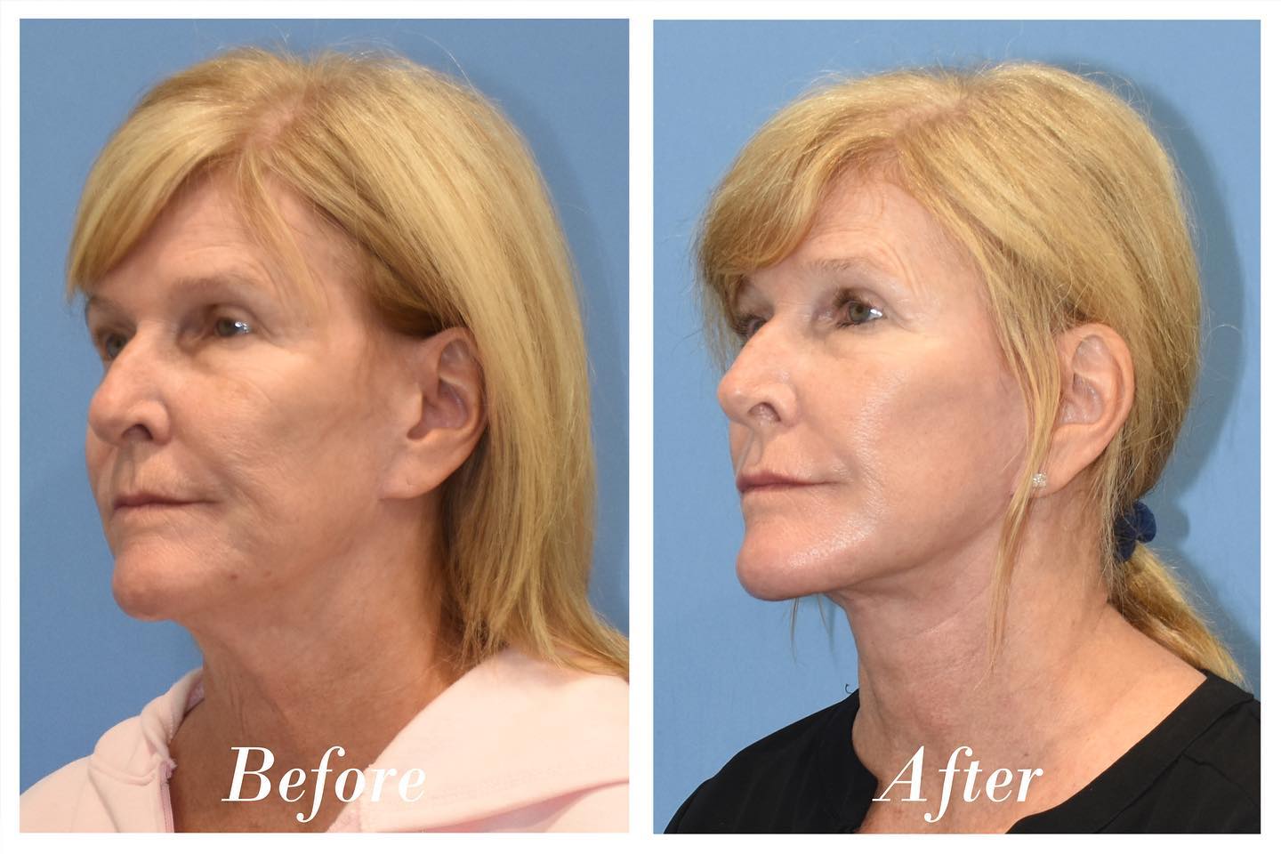 C02 Laser Before & After Image