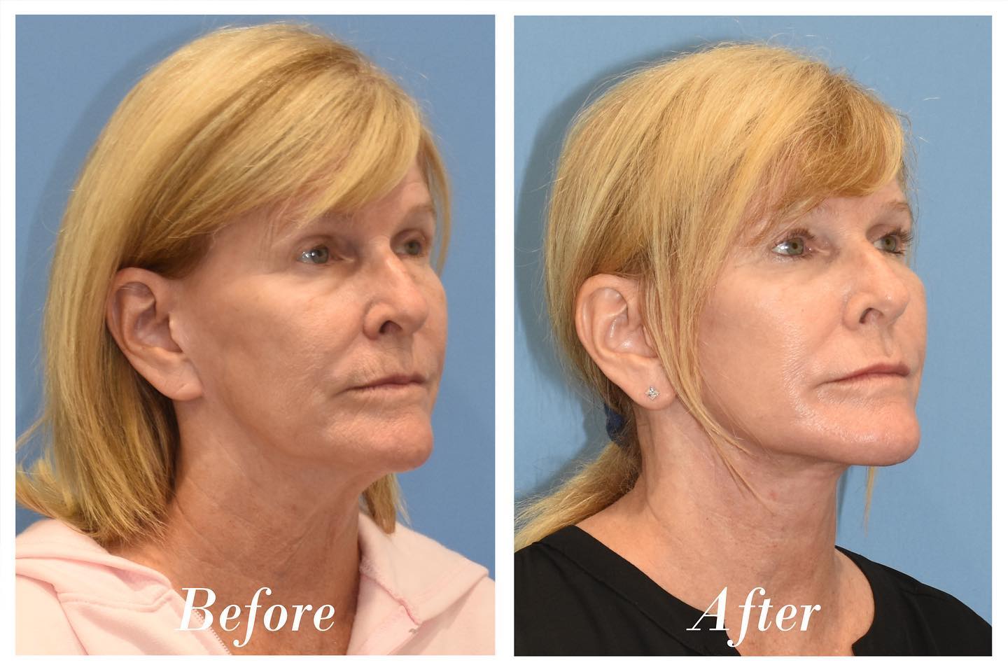 C02 Laser Before & After Image