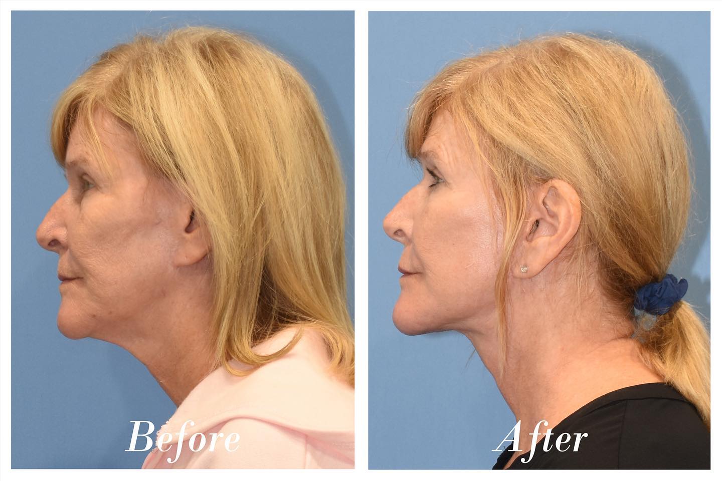 C02 Laser Before & After Image