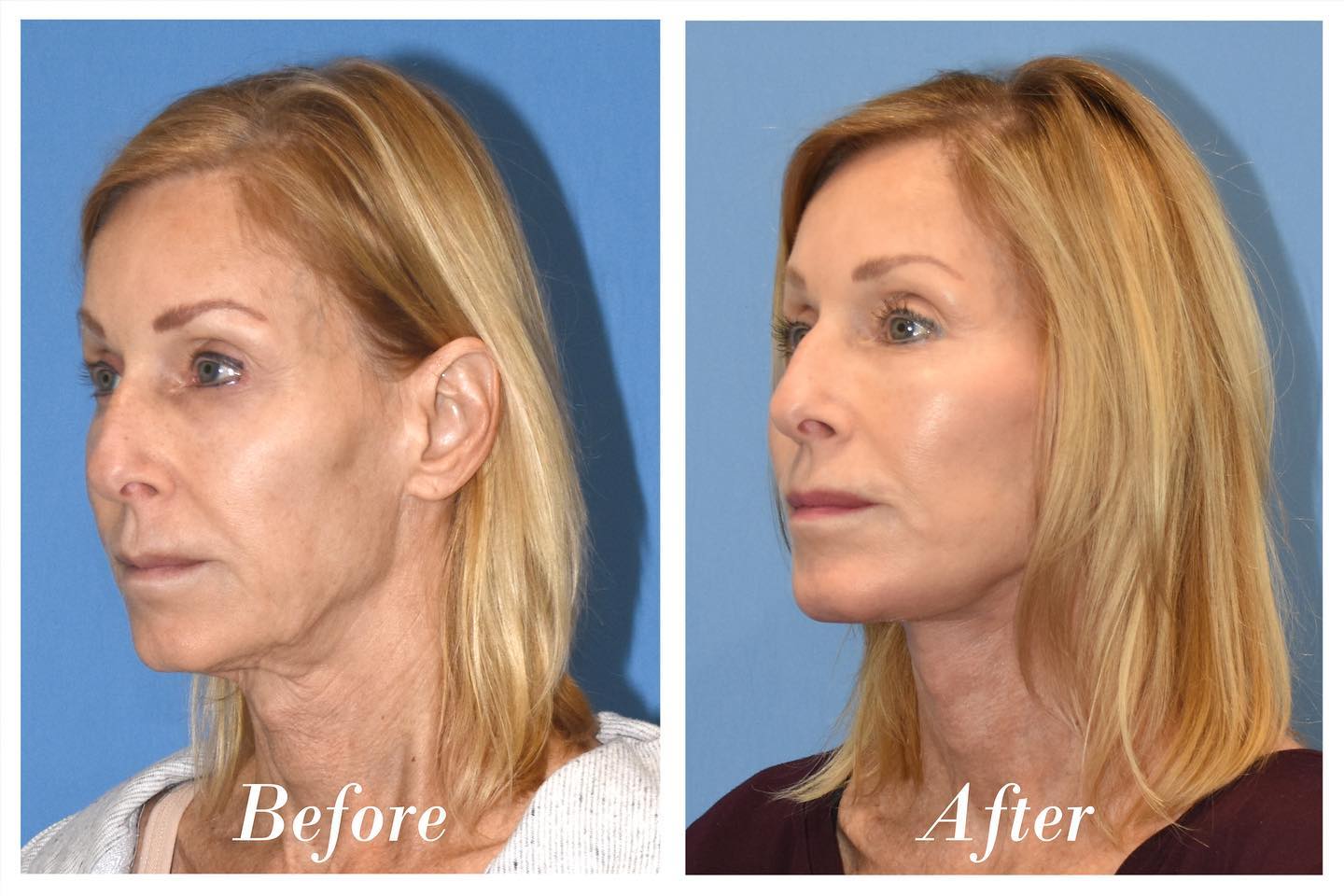 C02 Laser Before & After Image