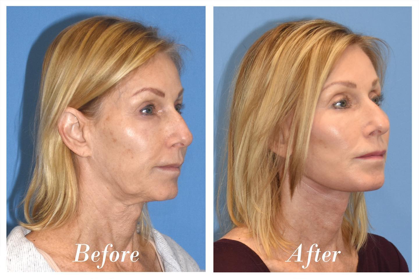 C02 Laser Before & After Image