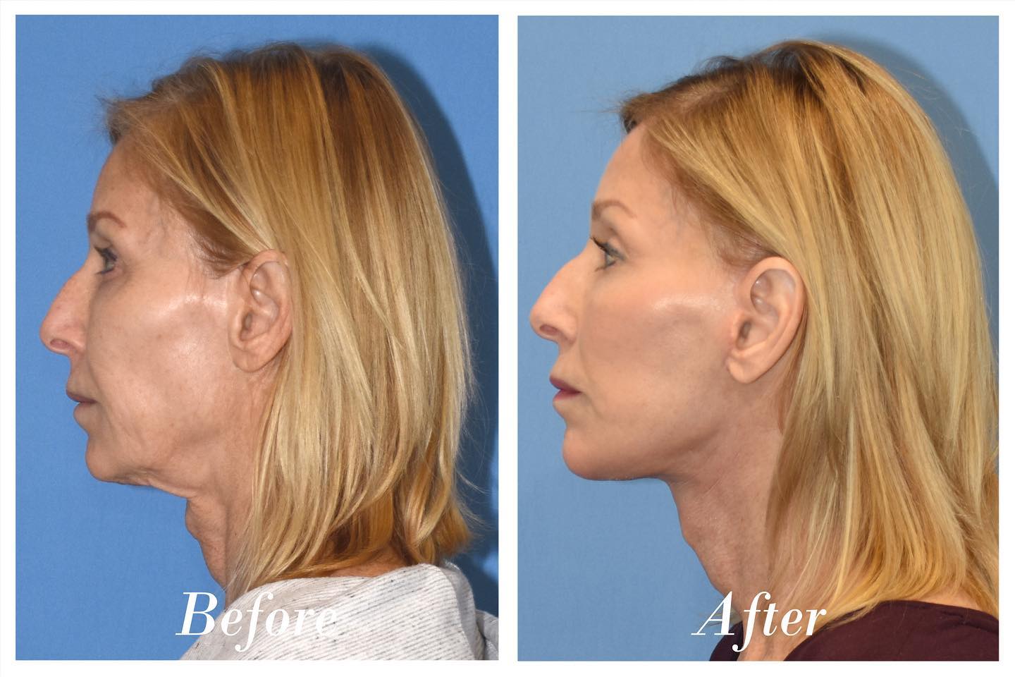 C02 Laser Before & After Image