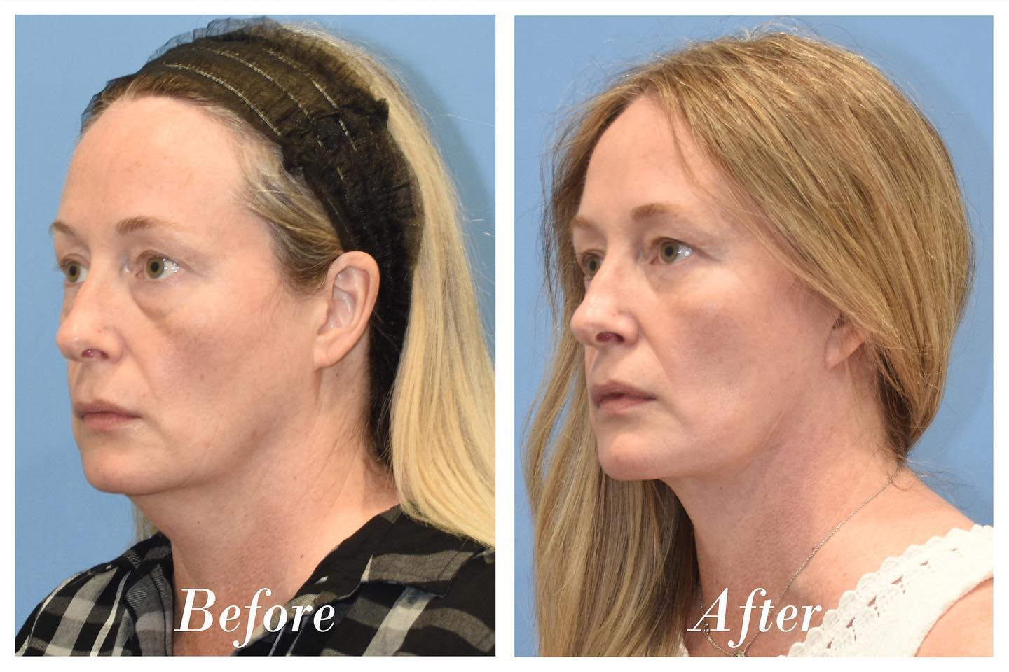 Facelift Lower Transconjunctival Blepharoplasty Before & After Image
