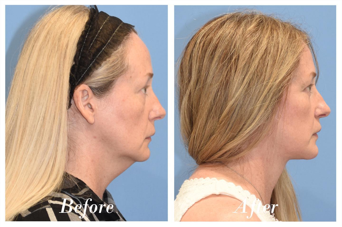 Transconjunctival Blepharoplasty Before & After Image