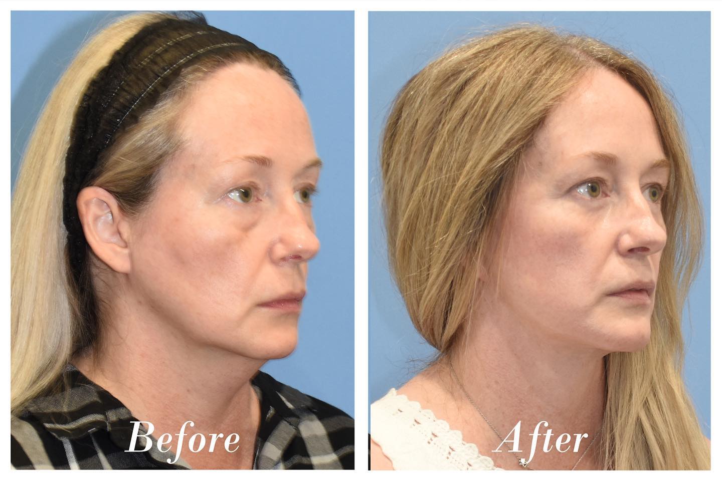 Facelift Lower Transconjunctival Blepharoplasty Before & After Image