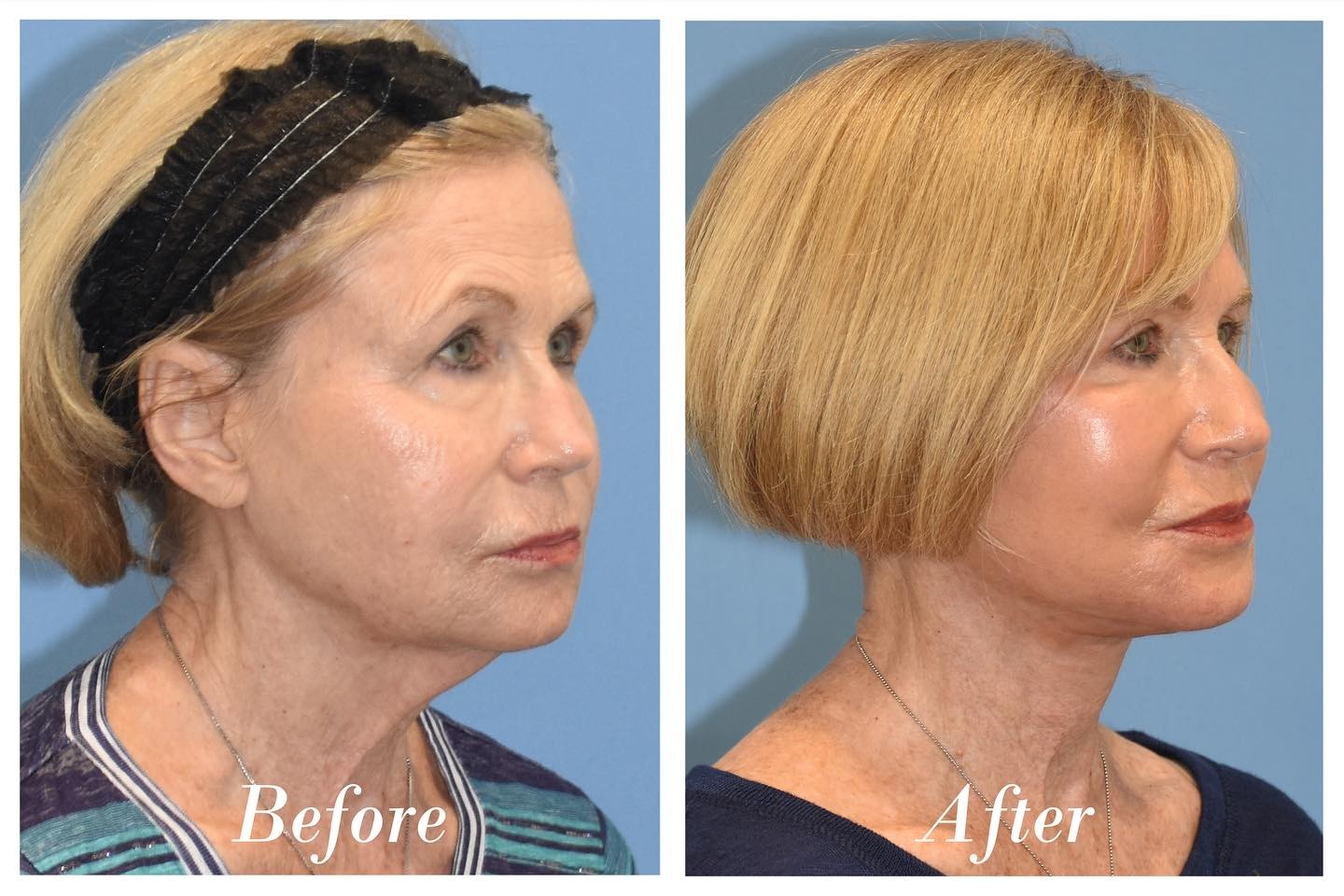 Facelift Upper Blepharoplasty Before & After Image