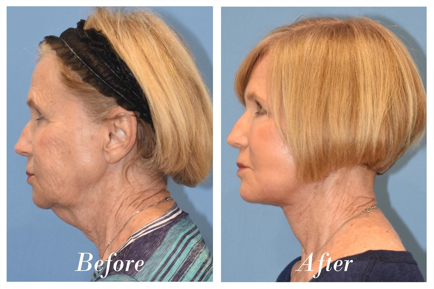 Facelift Upper Blepharoplasty Before & After Image