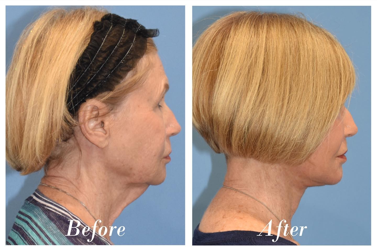 Facelift Upper Blepharoplasty Before & After Image