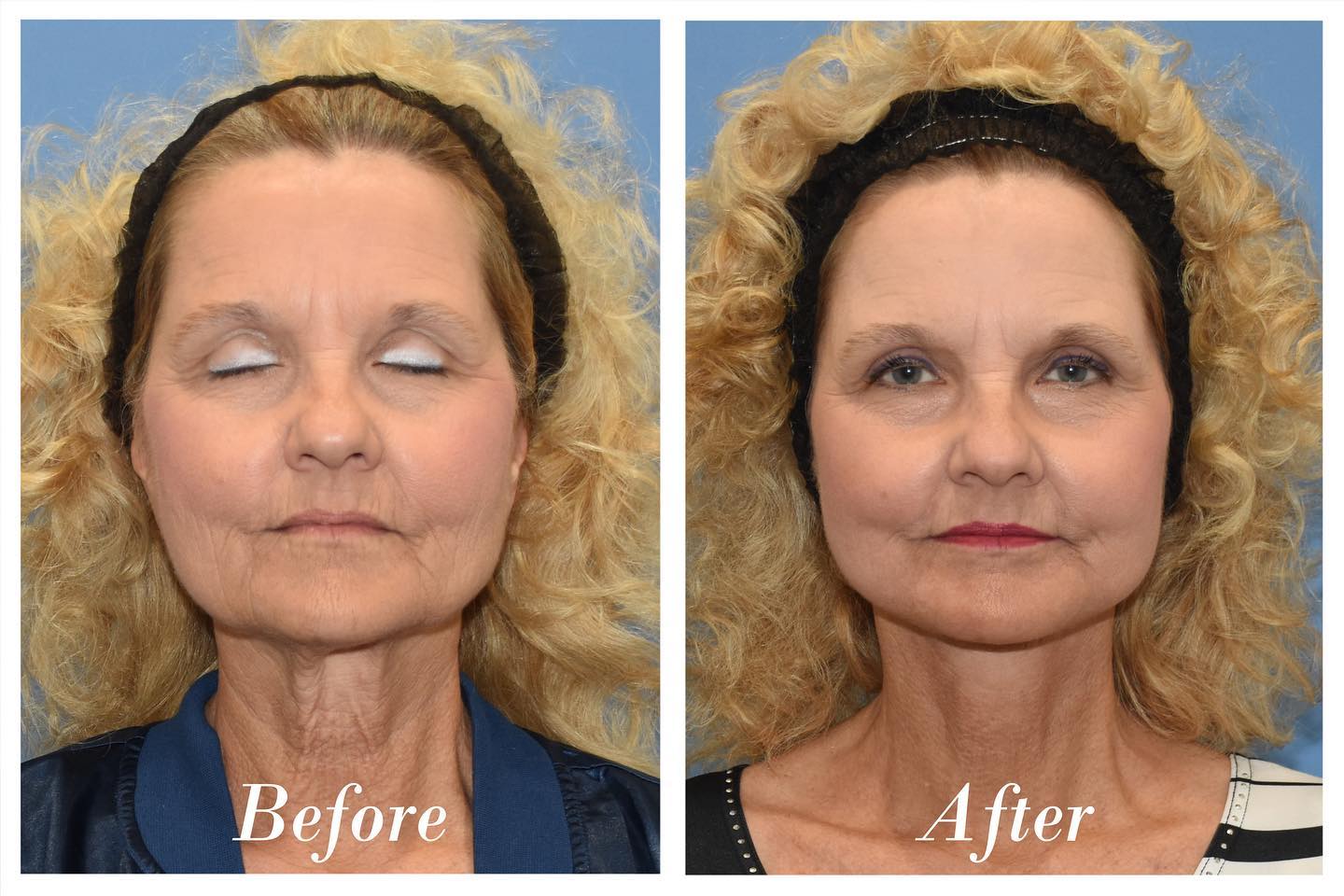 Facelift Upper Blepharoplasty Before & After Image