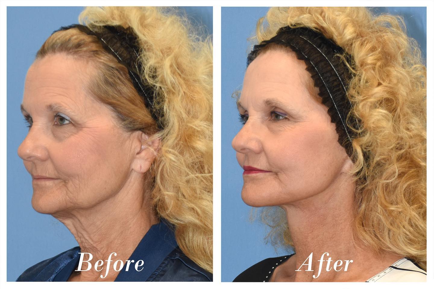 Facelift Upper Blepharoplasty Before & After Image