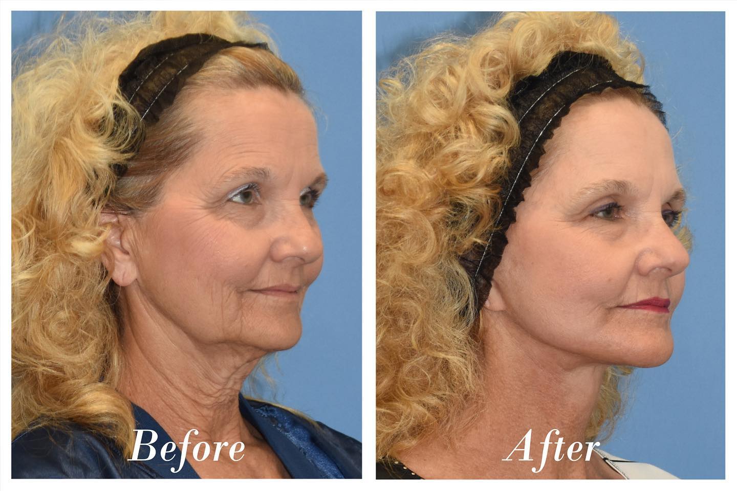 Facelift Upper Blepharoplasty Before & After Image