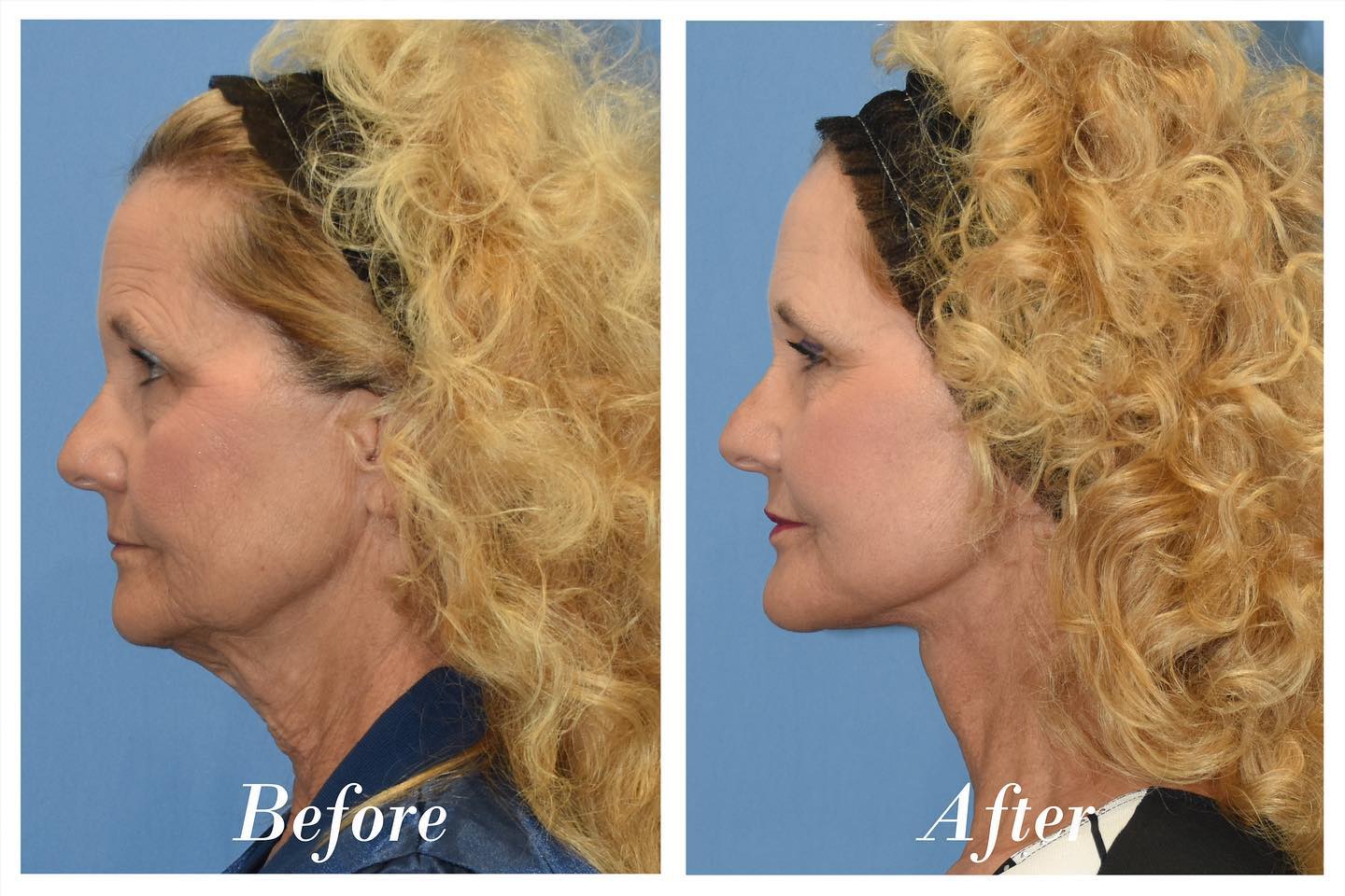 Facelift Upper Blepharoplasty Before & After Image