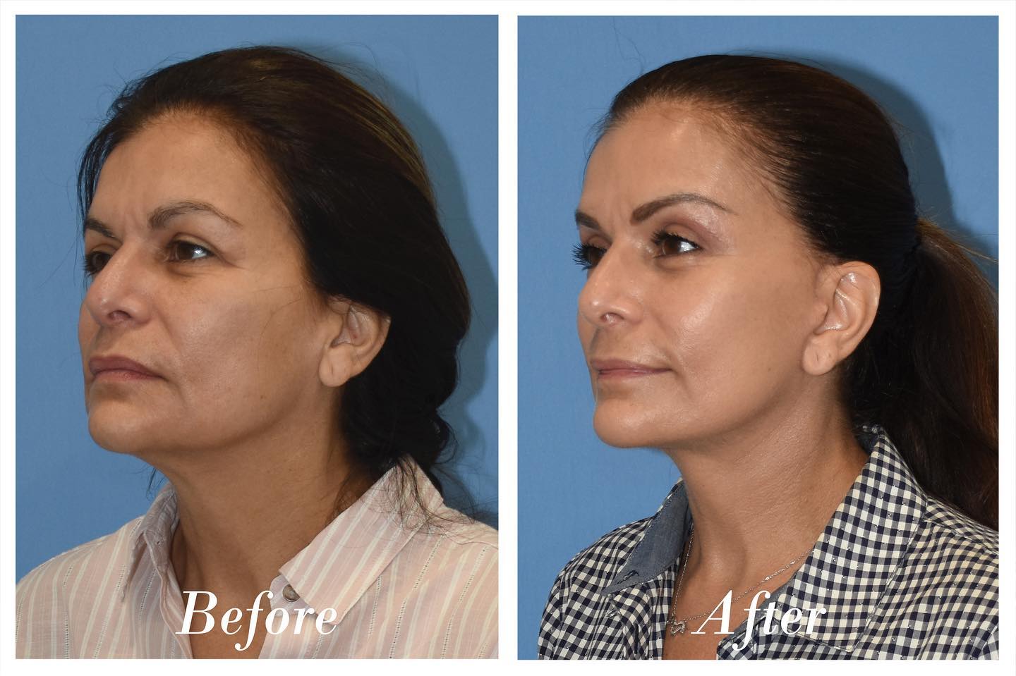 Facelift Upper Blepharoplasty Before & After Image