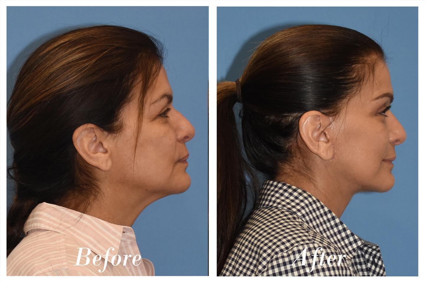 Facelift Upper Blepharoplasty Before & After Image