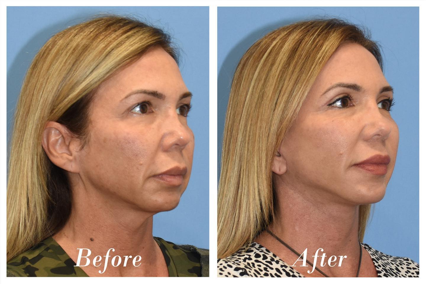 Facelift Upper Blepharoplasty Before & After Image