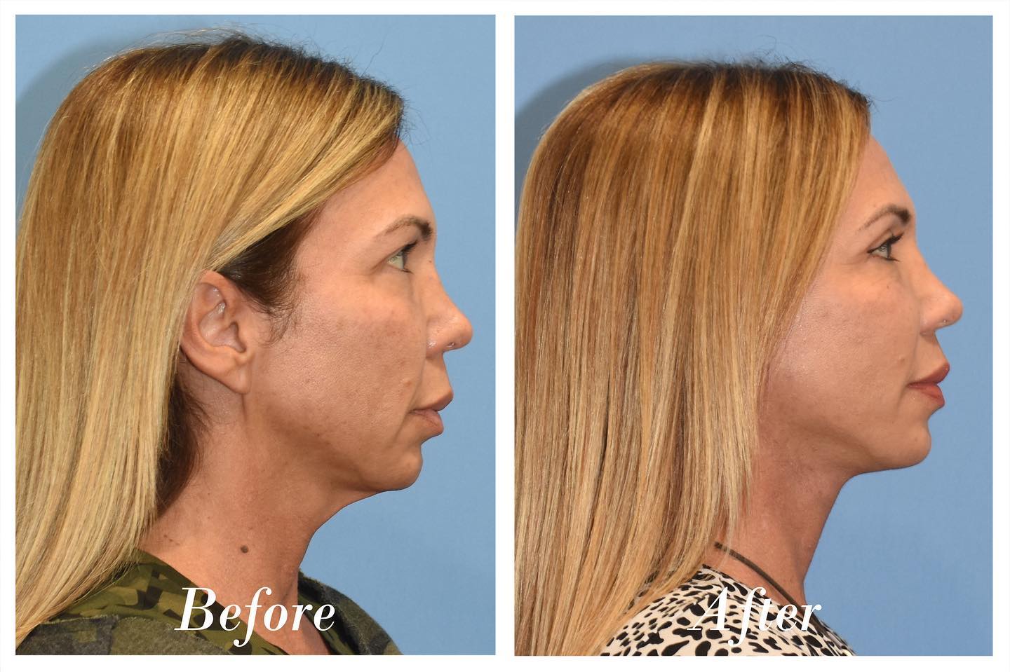 Facelift Upper Blepharoplasty Before & After Image