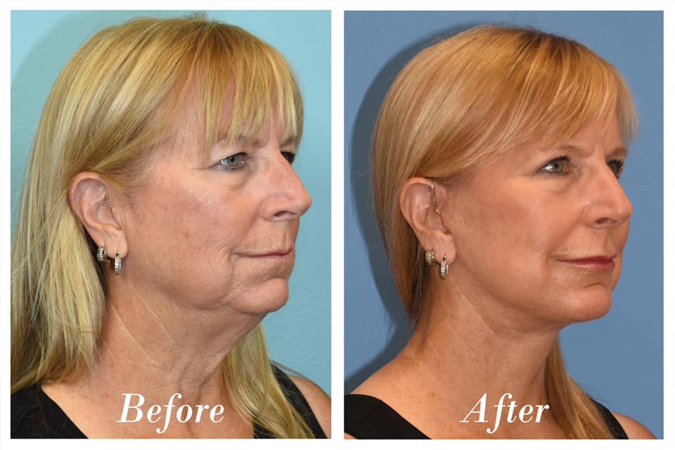 Facelift Upper Blepharoplasty Before & After Image