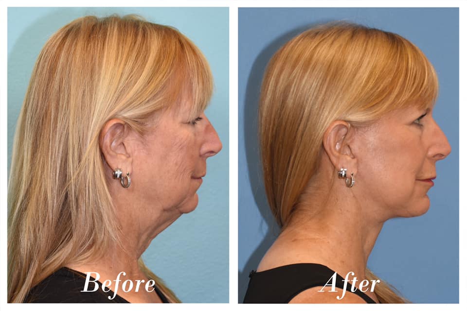 Facelift Upper Blepharoplasty Before & After Image