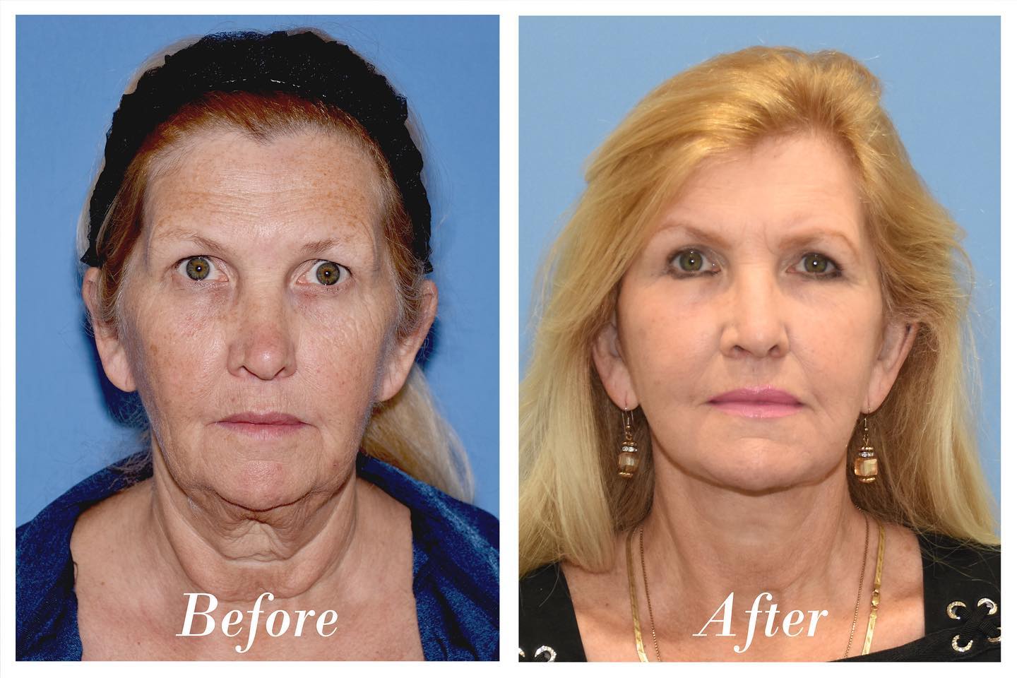 Facelift Upper Blepharoplasty Before & After Image