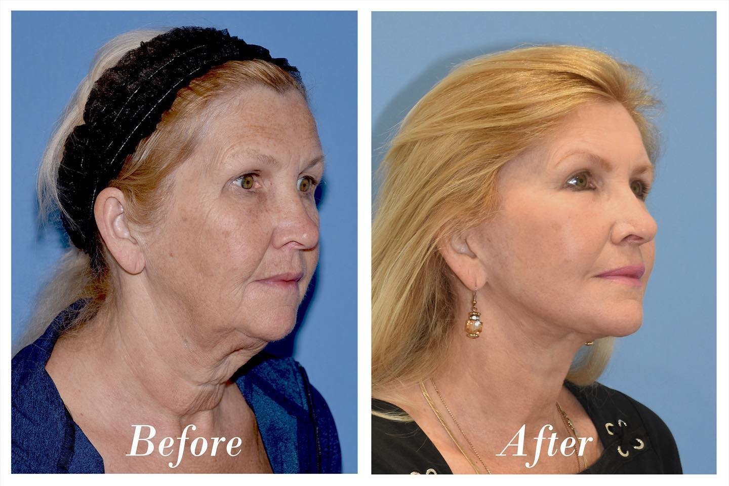 Facelift Upper Blepharoplasty Before & After Image