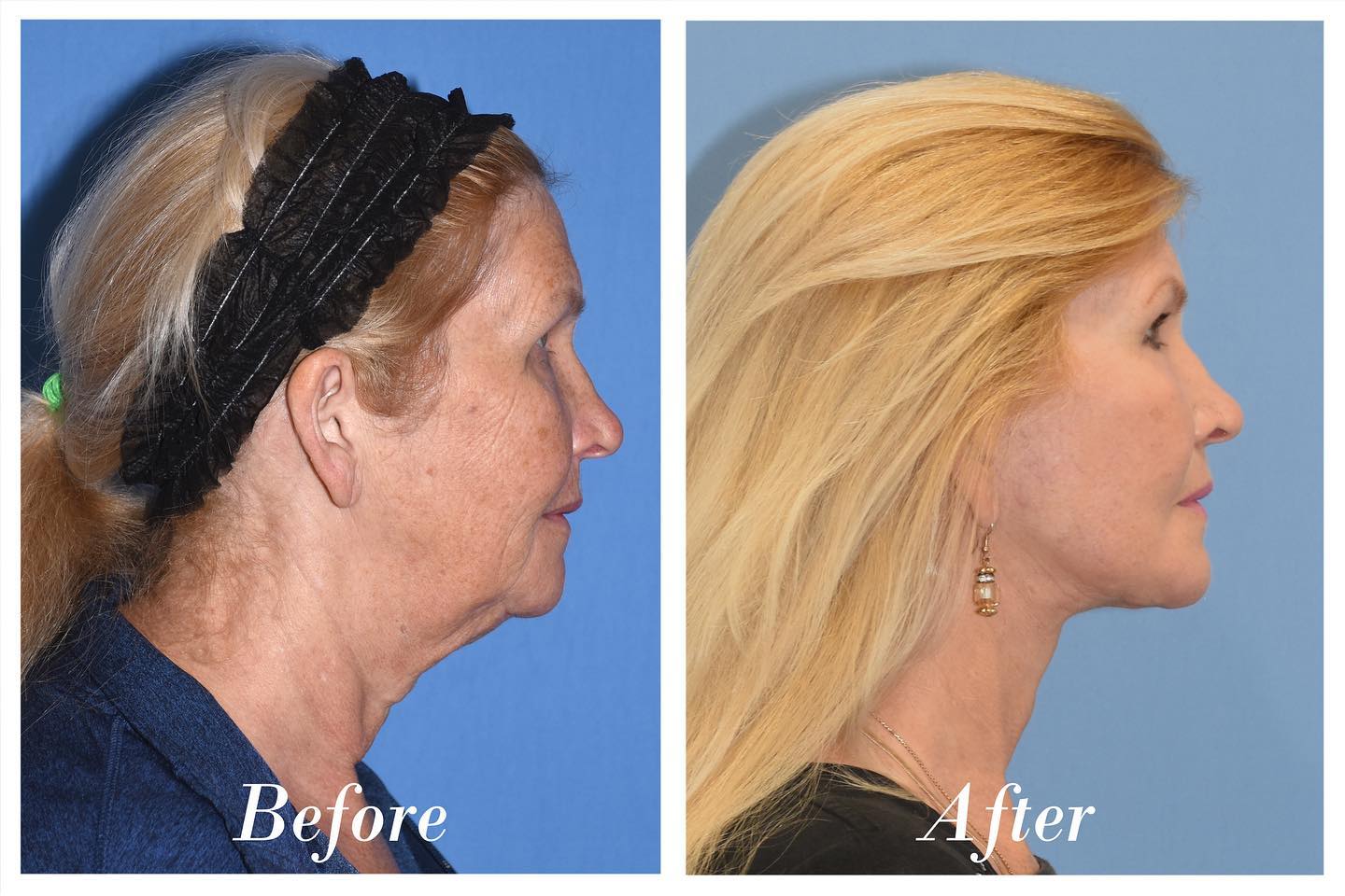 Facelift Upper Blepharoplasty Before & After Image