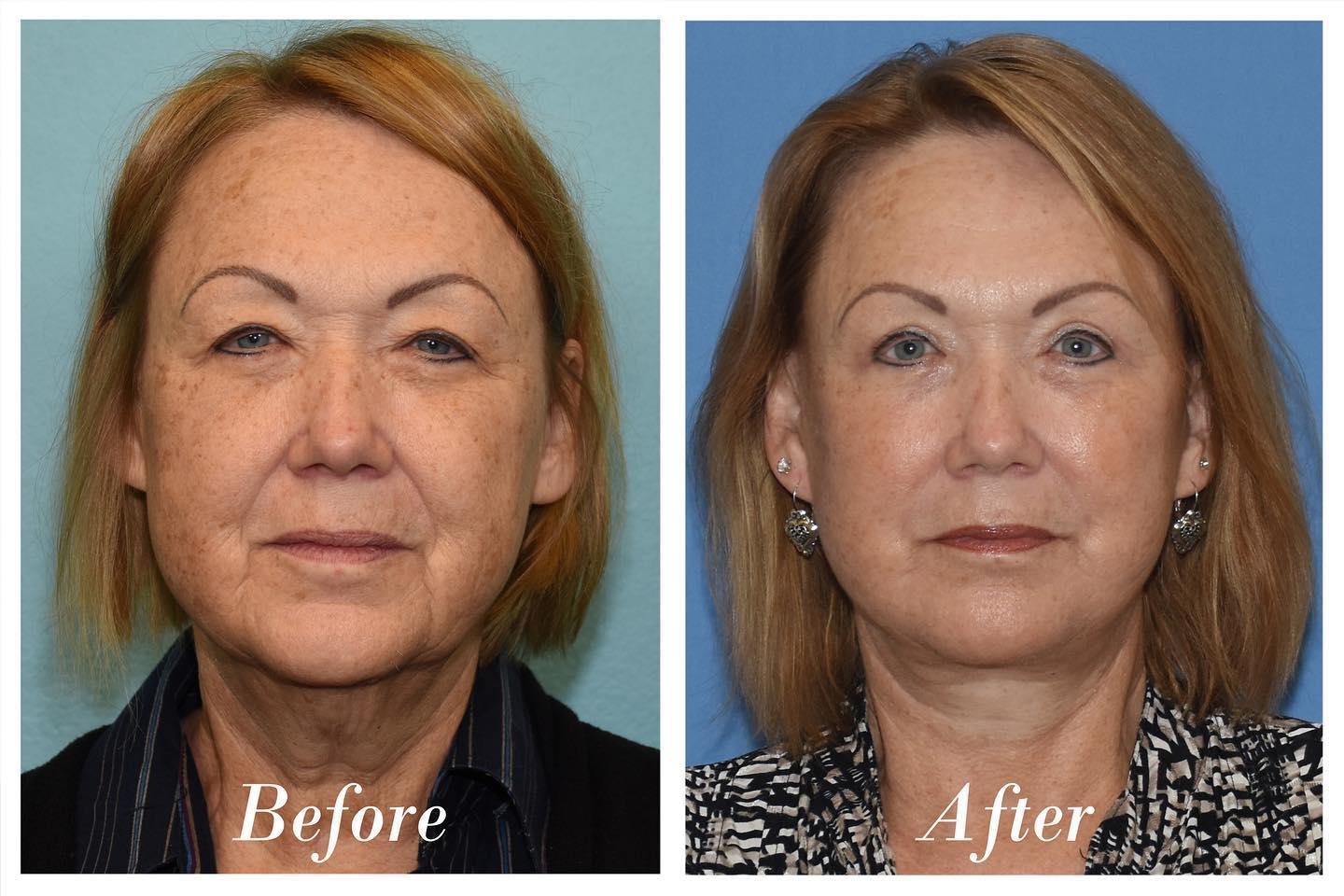 Facelift Upper Blepharoplasty Before & After Image