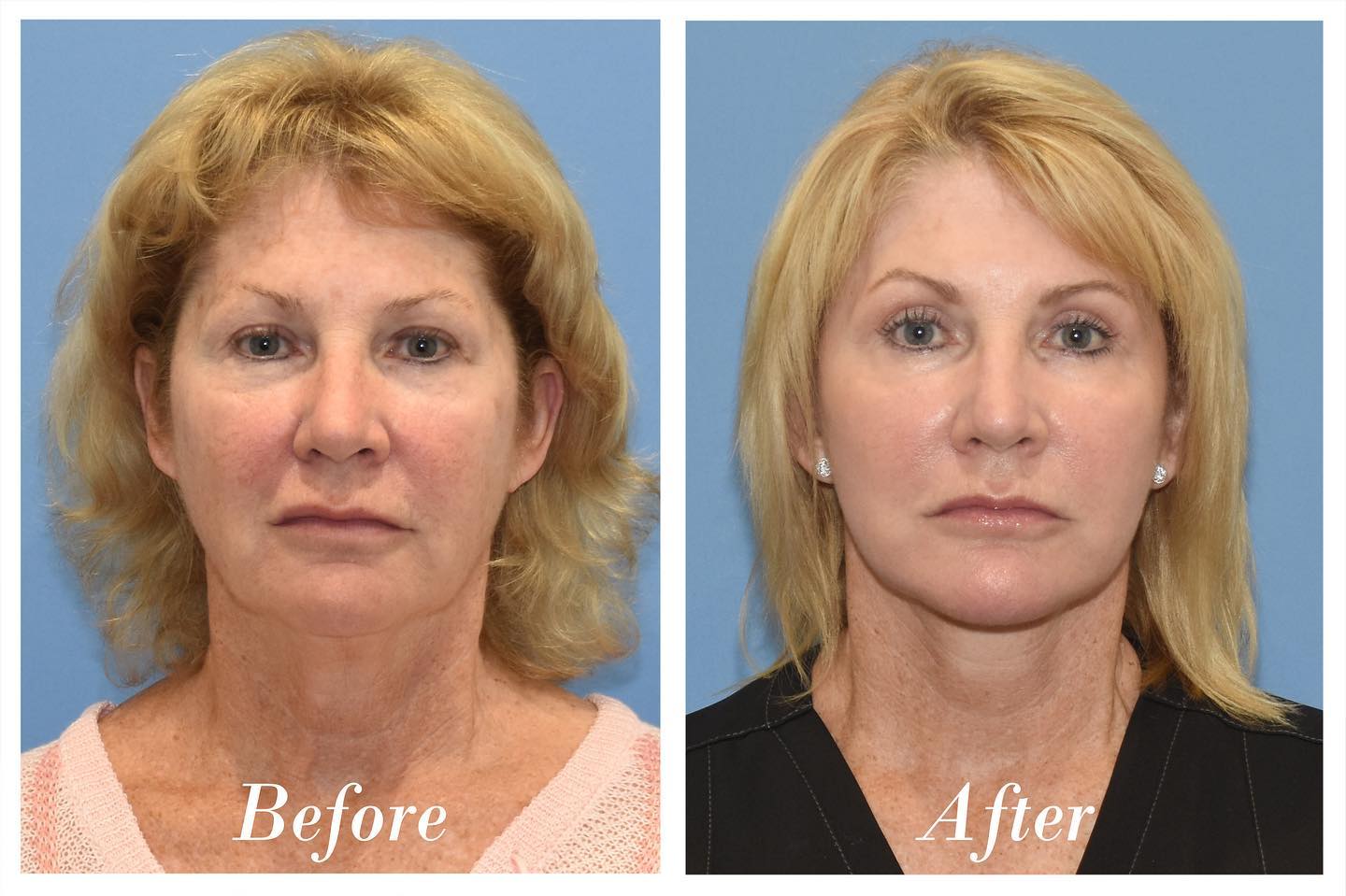 Facelift Upper Blepharoplasty Before & After Image