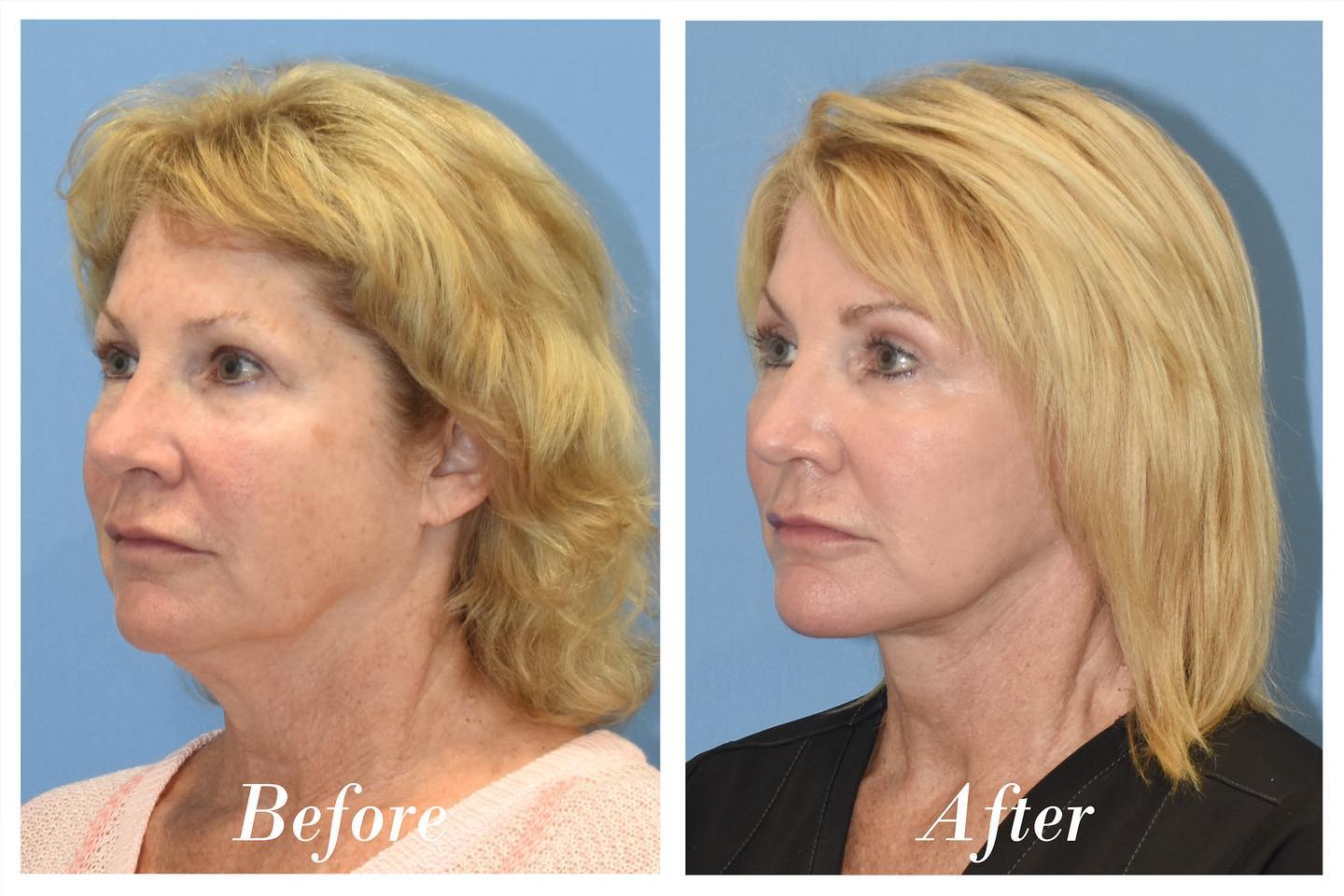 Facelift Upper Blepharoplasty Before & After Image