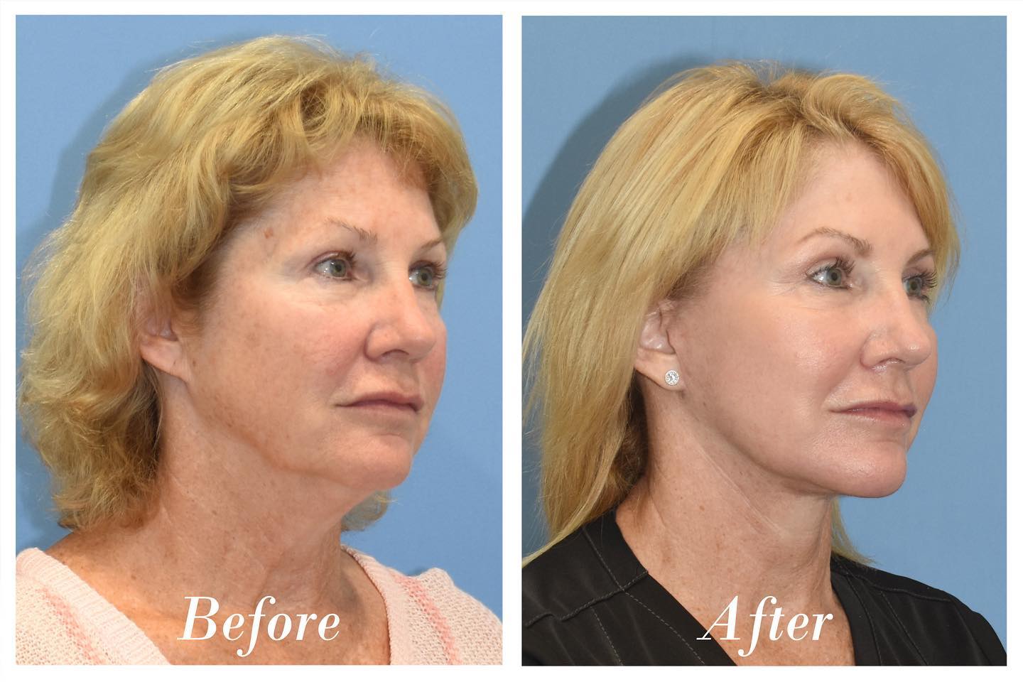 Facelift Upper Blepharoplasty Before & After Image